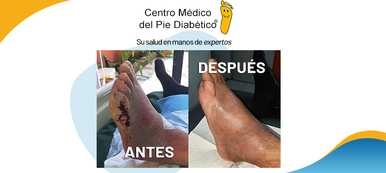 ÚLCERAS